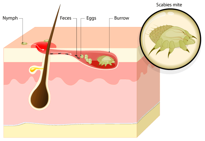 Diagram illustraiting the Scabies mite burrow under the skin - adjacent a hair follicle. High lighting the mite, burrow, eggs, feces and nymph.